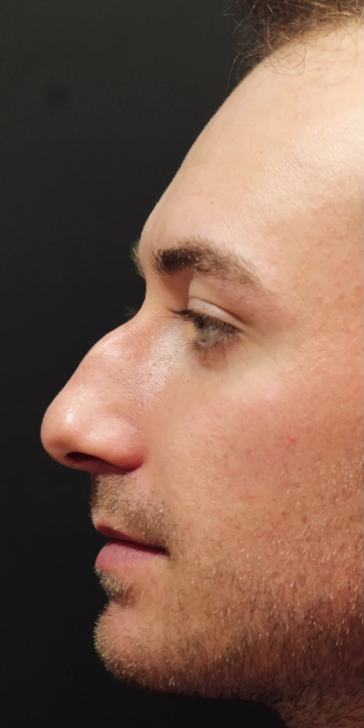Antes: paciente de perfil
